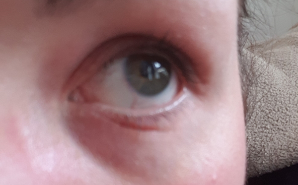 Under eye crease - pic attached