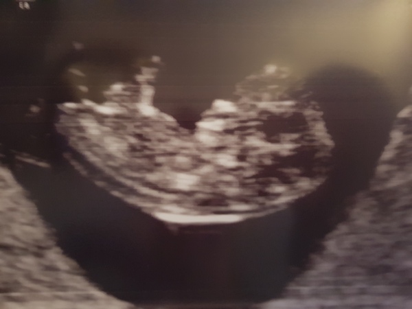 Sonographer said baby’s bowels were on the outside