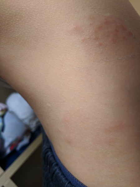 Bedbugs? Molluscum? Help!