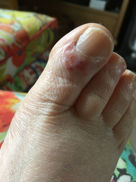 What is this rash on toe? (Photo)