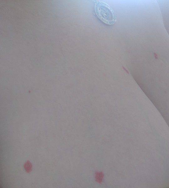 Anyone know anything about red patchy skin conditions? Pics attached.