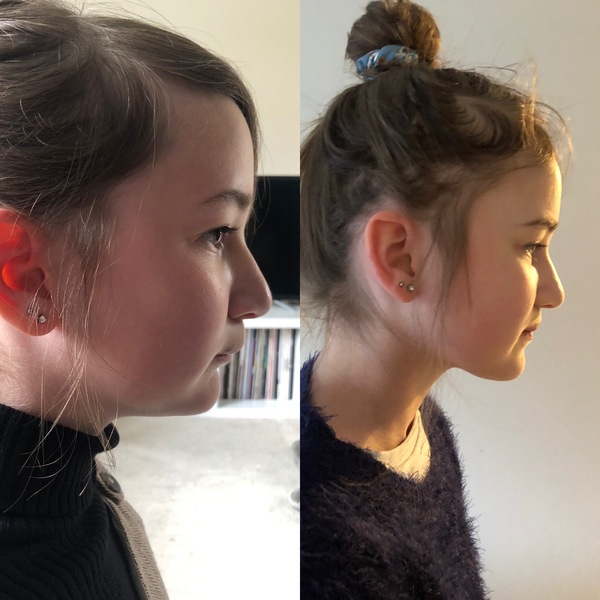 Twin Block Braces - Any Advice?