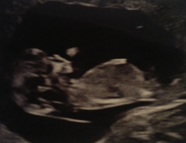 12 week scan gender?