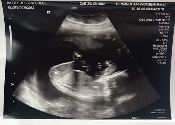 20 week scan guess! Boy or girl?