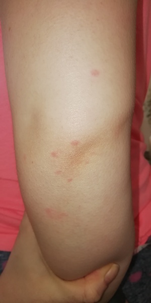 Rash or Pox