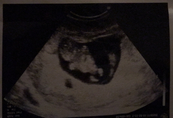 7 week scan - really nervous