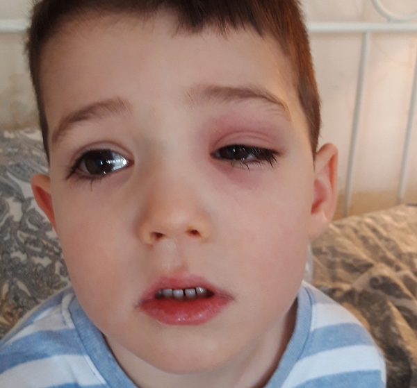 Periorbital cellulitis - please help!