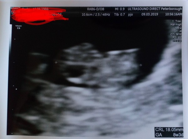 Early scan pictures