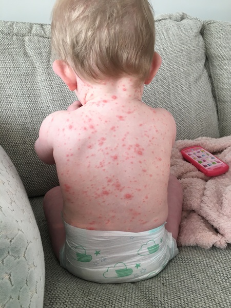 Chicken pox