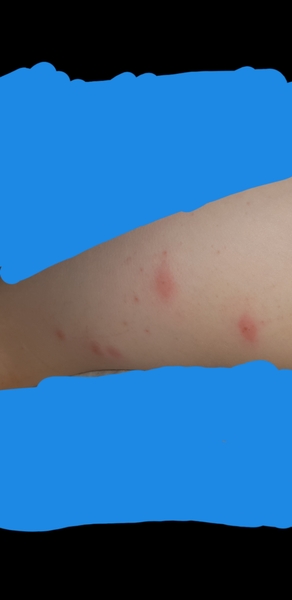 What is biting us ?!