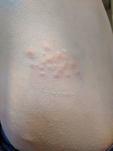 Bedbugs? Molluscum? Help!