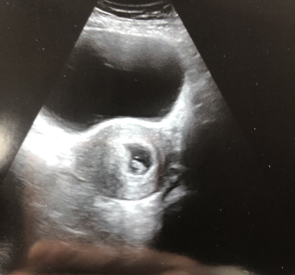 7 week scan - really nervous