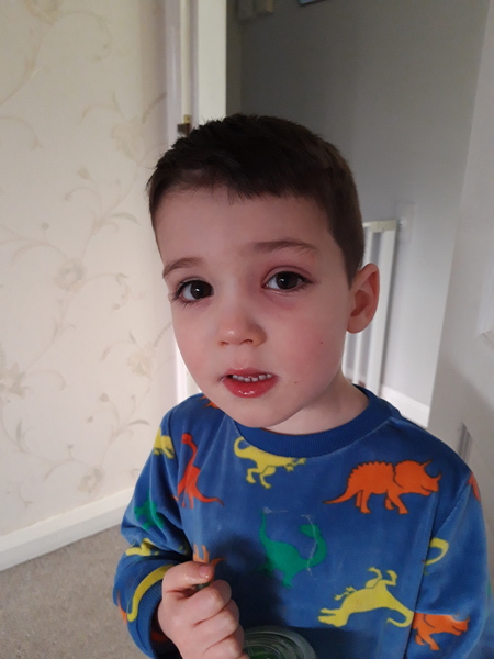 Periorbital cellulitis - please help!