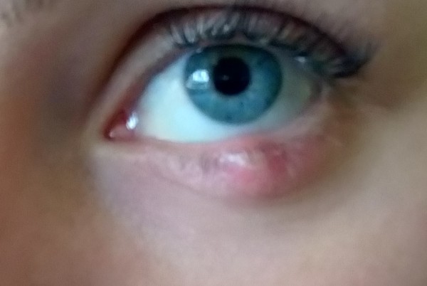 Gross lump/stye on eyelid.