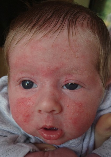 Spots/rash