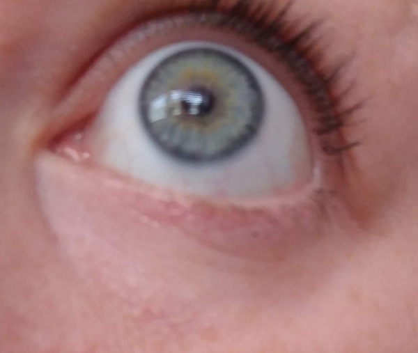 Those white, fatty lumps.Teenager, how to clear.