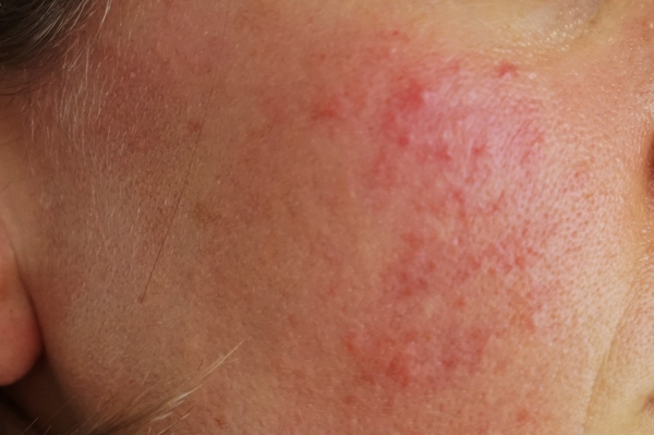 To ask what you think this acne is (pic)