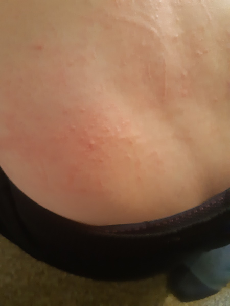 Rash