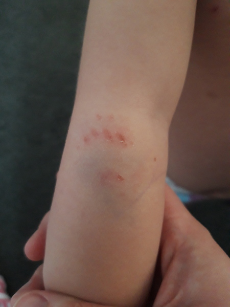 In-laws dog bit toddler
