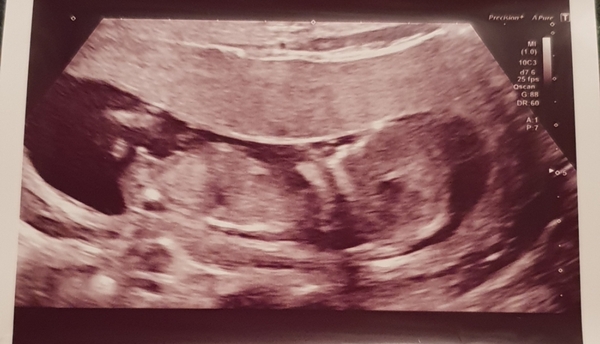Boy or Girl? Have a guess!