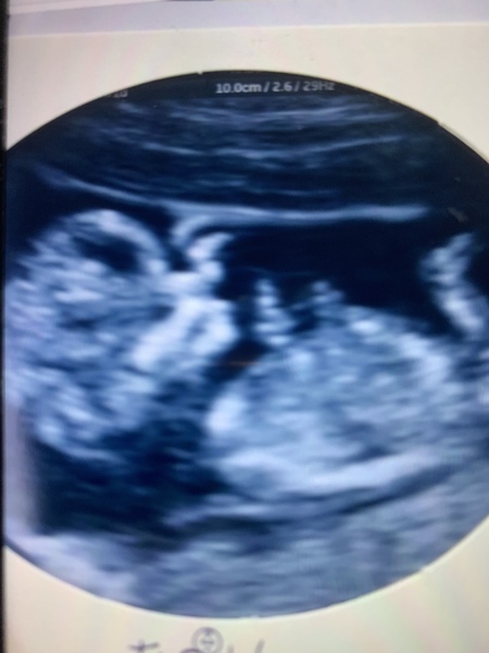 12 week scan gender?