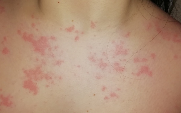 Rash or Pox