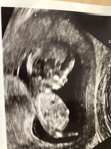 BFP after IVF/ ICSI