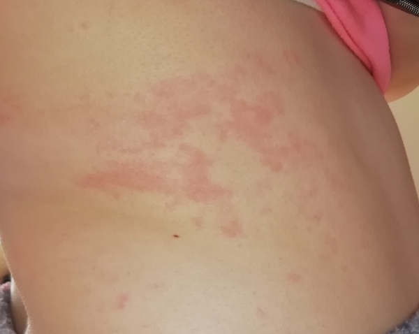 Rash or Pox