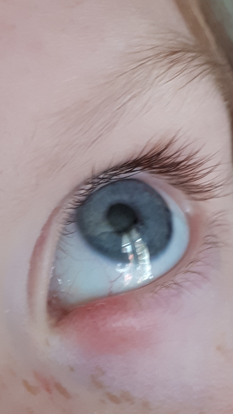 eye thing