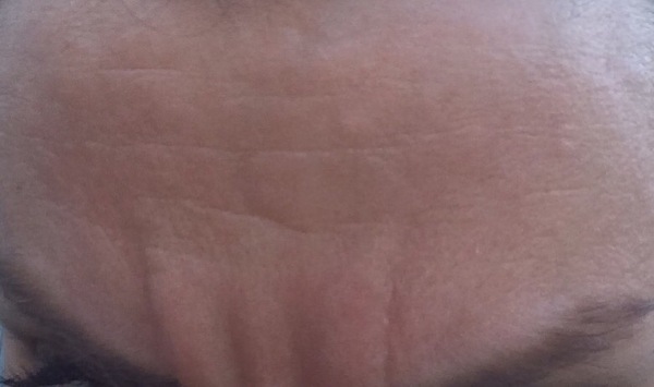 Health anxiety and botox