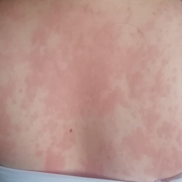 Rash or Pox