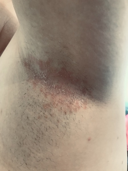 Weird red blotchy armpit