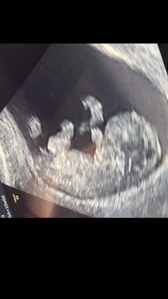Sonographer said baby’s bowels were on the outside