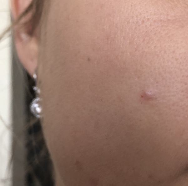 Thought this was a milia... er perhaps not?! Help?!