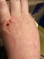 Blood test positive for antibodies - now what?