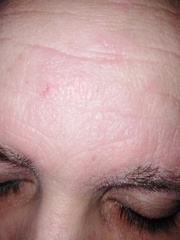 Skin peeling off eyelids. *pics included*
