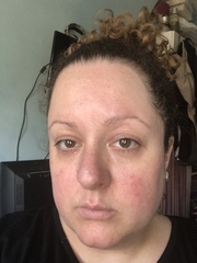 To be fed up of still having skin like a teenager?