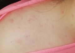 Rash or Pox
