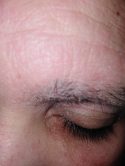 Skin peeling off eyelids. *pics included*