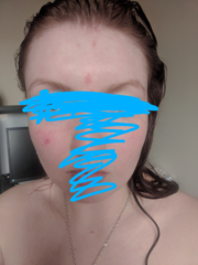 Anyone know anything about red patchy skin conditions? Pics attached.