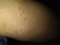 Help-what is biting me??