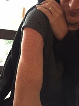DH ill for months and no anti-b's given, now more worrying