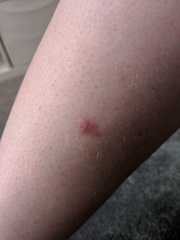 Anyone know anything about red patchy skin conditions? Pics attached.