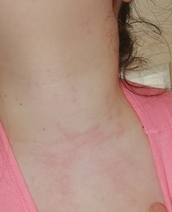Rash or Pox