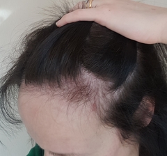 Hair loss help (pics included)