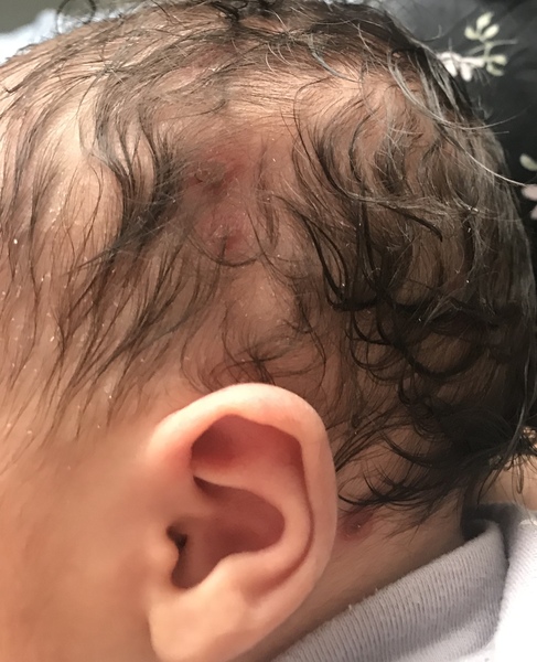 HSV1 and Pregnancy/Childbirth + neonatal herpes experience