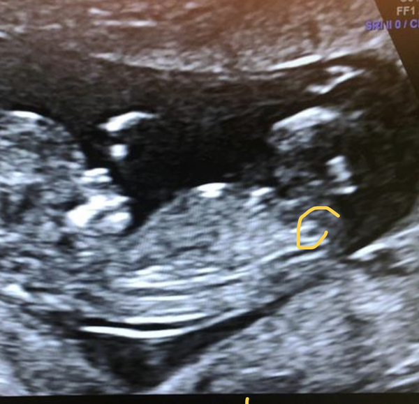 Boy or girl- any guesses?? Nub / skull/ other theories?