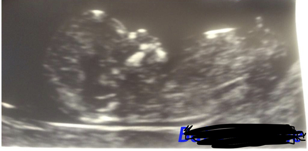 Boy or girl- any guesses?? Nub / skull/ other theories?