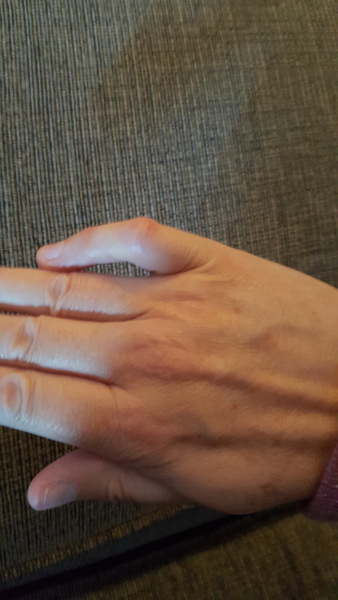 Toddler with bent little finger