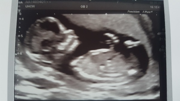 Boy or Girl?